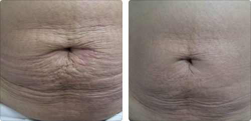 Lipo-Ex, Fat Reduction in Wilson, Raleigh, NC | True Radiance Medi Spa