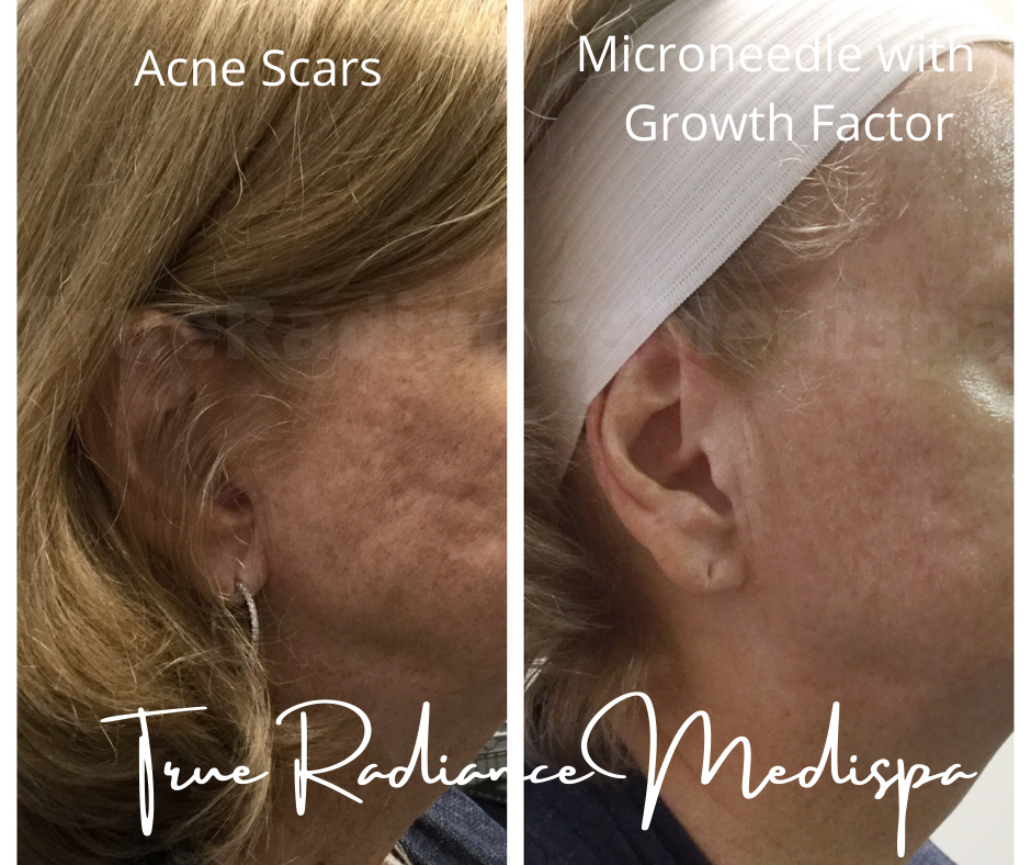 microneedle